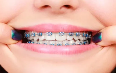 traditional-metal-brace